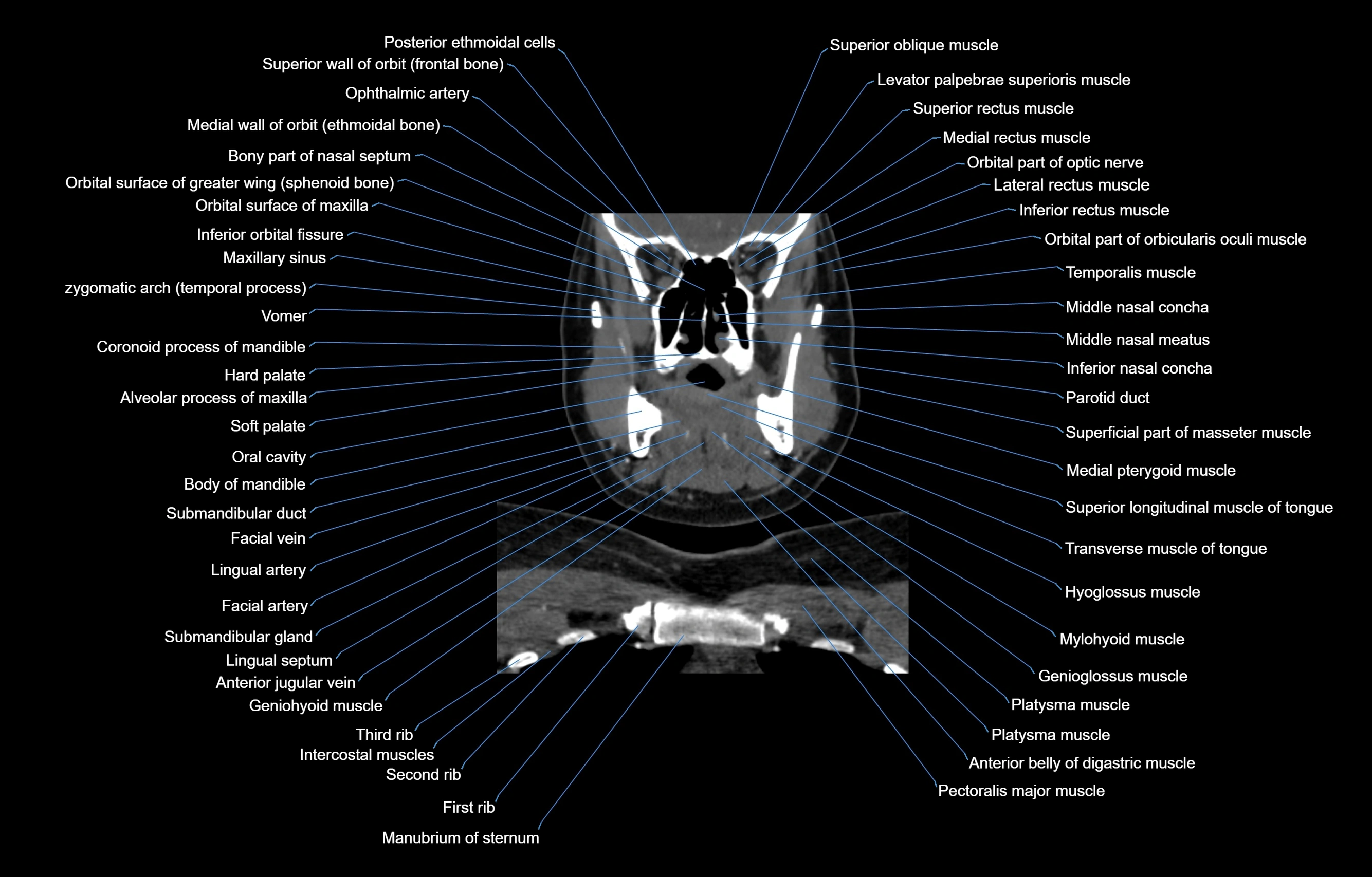 CT Neck coronal  cross sectional anatomy labelled 3D  radiology  image-00022.webp